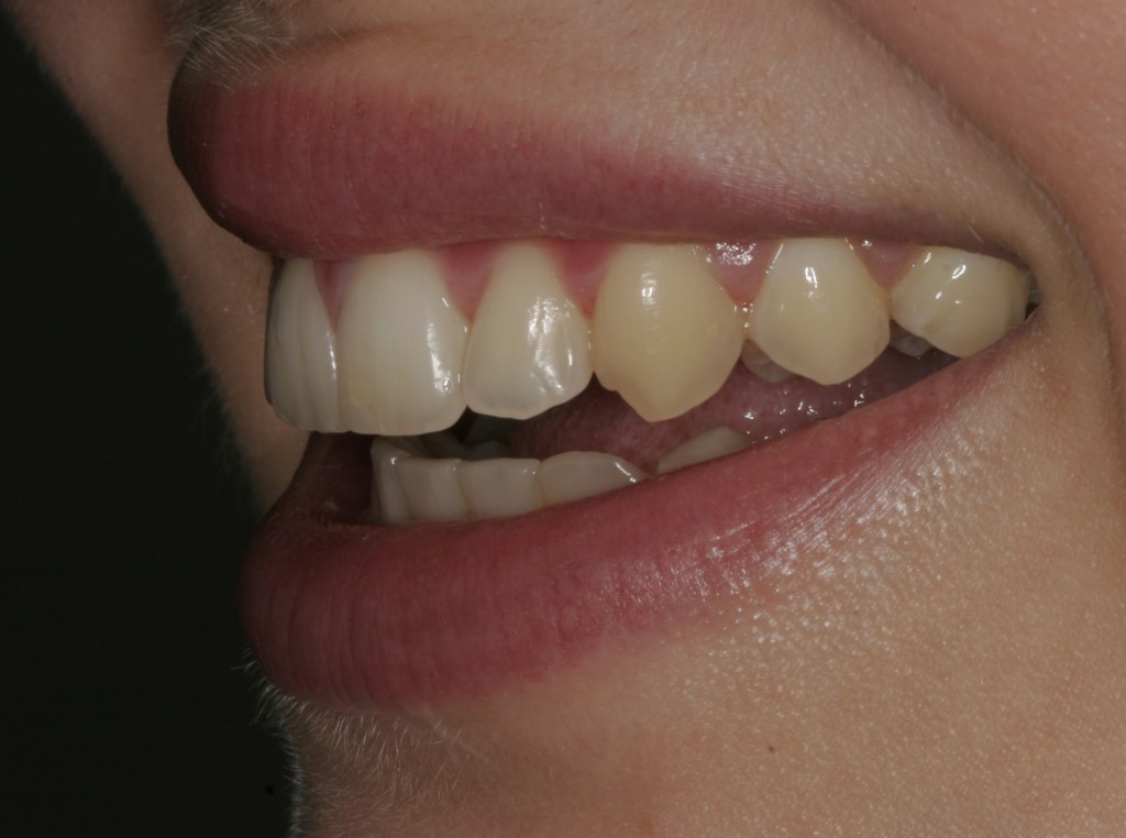 Inman Aligner - After 6 Weeks Inman Aligner Shropshire