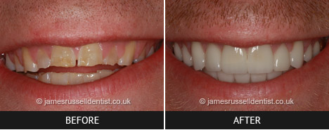 EB-bruxist and Veneers