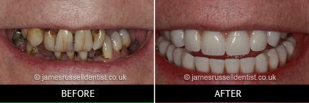 Implant