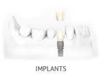Implants