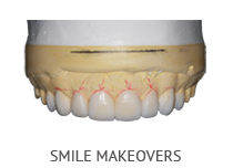 Smile Makeover