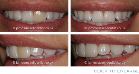 veneers