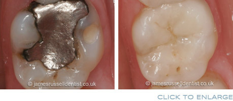 Fillings