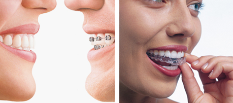Invisalign Banner